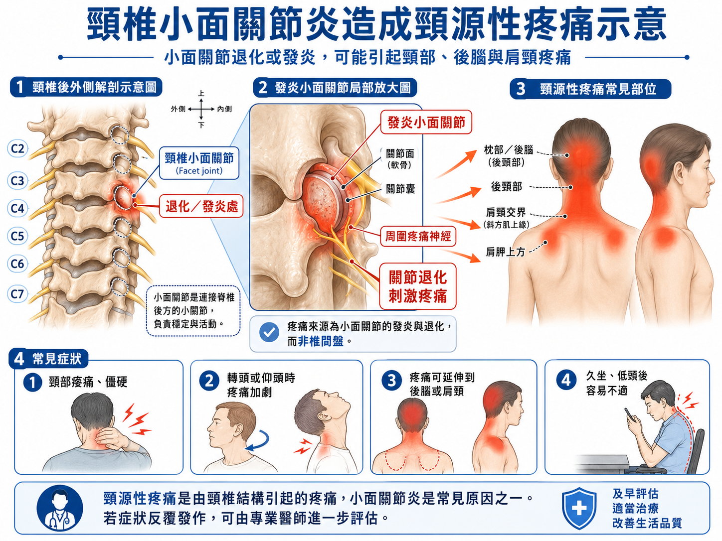 頸椎小面關節炎造成頸源性疼痛示意